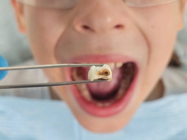 Best Emergency Dental Extractions in Carbon Cliff, IL
